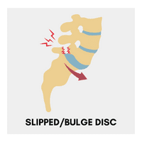 14. Slipped bulge disc